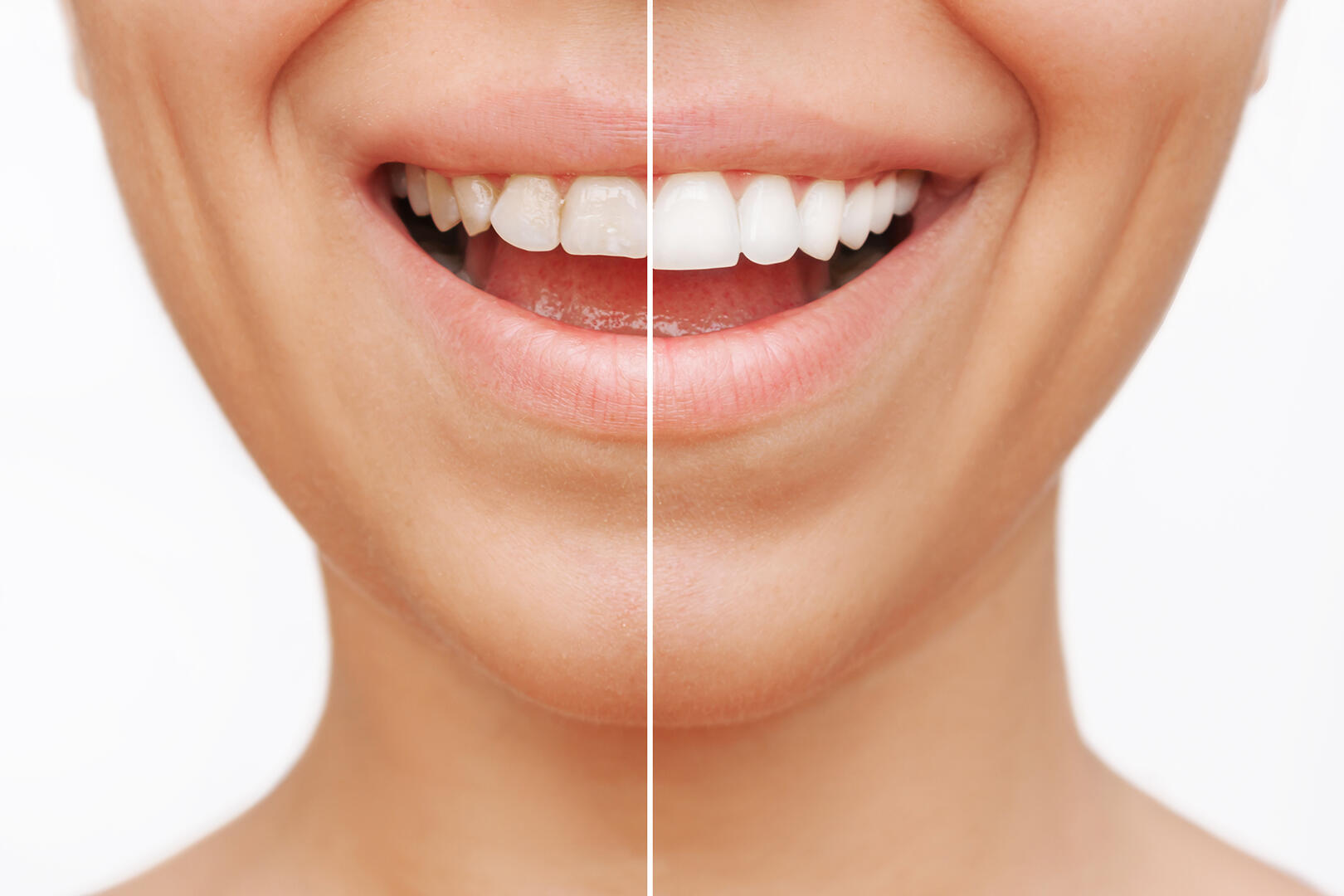 Cropped shot of a young caucasian smiling woman before and after veneers installation